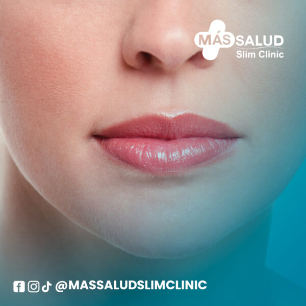 Relleno de labios ácido hialurónico
