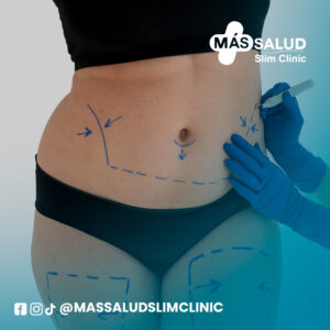 Mesoterapia (1 sesión)