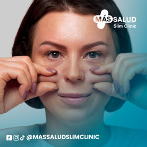 Recuperación de pómulos y correción de ojeras