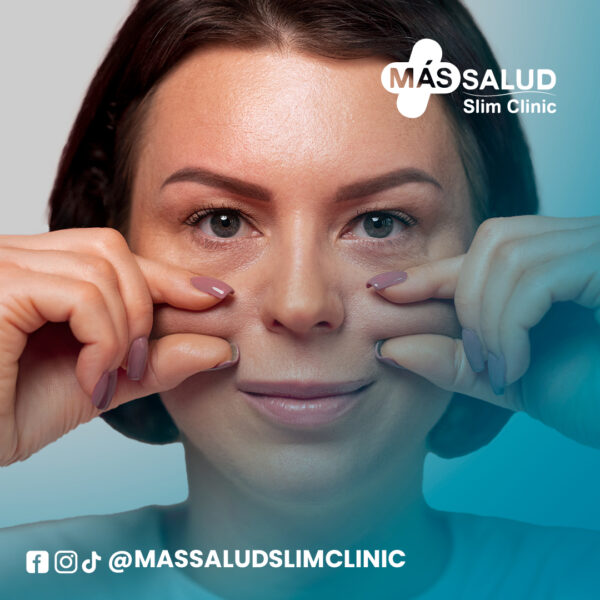 Recuperación de pómulos y correción de ojeras